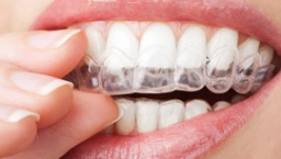 5 riscos que o clareamento dentário pode trazer quando não é feito pelo dentista