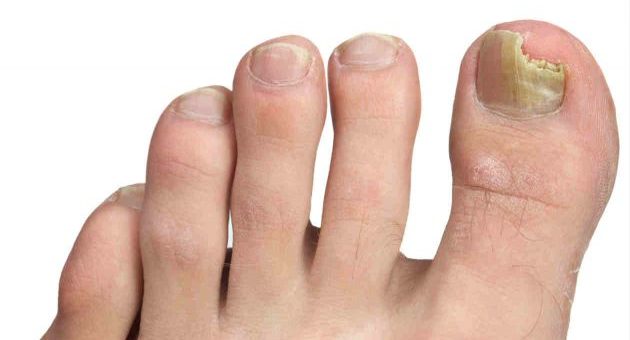Saiba como tratar a micose de unha e o que fazer para evitá-la
