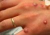 Ministério da Saúde confirma 76 casos de varíola dos macacos no país