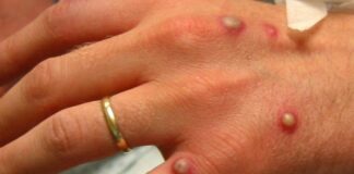 Ministério da Saúde confirma 76 casos de varíola dos macacos no país