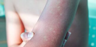 Conheça os sintomas da dengue, as fases da doença e os sinais de alerta