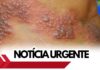 Casos de herpes zoster tem aumento expressivo no ABC