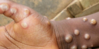 OMS declara mpox como emergência em saúde pública global