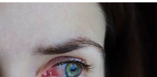 Gripe e resfriado aumentam casos de conjuntivite